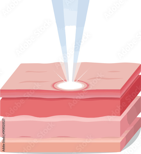 Isolated a realistic Cosmetic Laser Beam Treatment on Skin Layer Background, 3D Illustration vector art with white background.