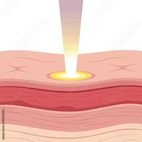 Isolated a realistic Cosmetic Laser Beam Treatment on Skin Layer Background, 3D Illustration vector art with white background.