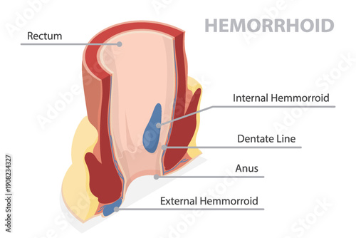 Cross section of the rectum and anal canal. Illustration of external and internal hemorrhoids structure. 3d flat vector isometric poster on white background.