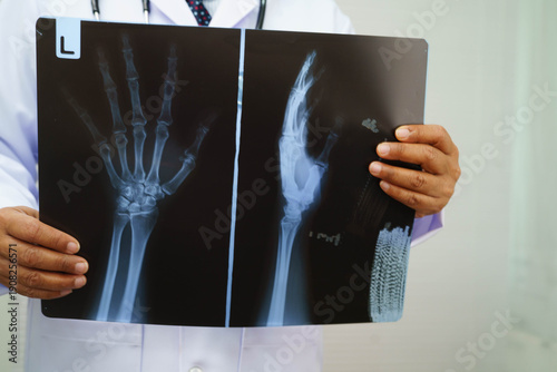 Quadro em tela Doctor examining hand ankle joint bone radiography xray film.