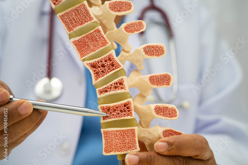 Doctor holding osteoporosis in back bone model for treatment medical in orthopedic department.