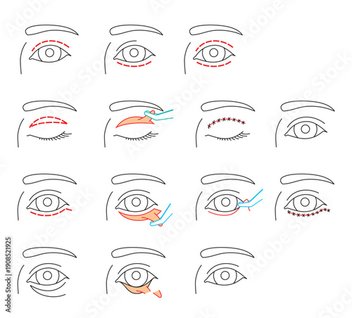 Blepharoplasty. Various cuts and consequences
