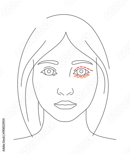 Illustration of blepharoplasty