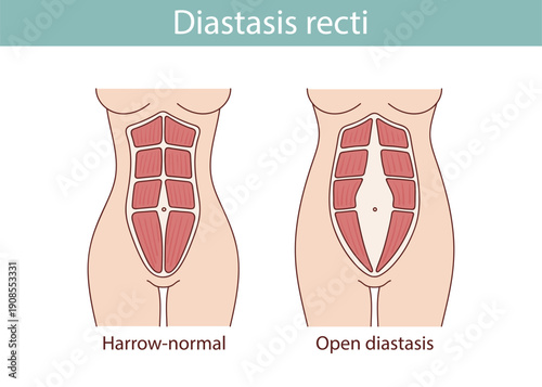 Different types of diastasis. Medical anatomical illustration.