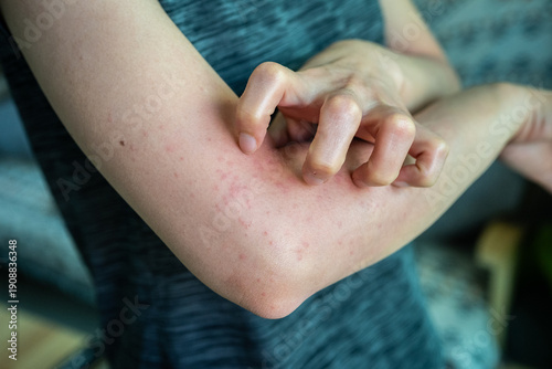 Fényképezés Cropped shot view of woman scratching her skin after rashes occur