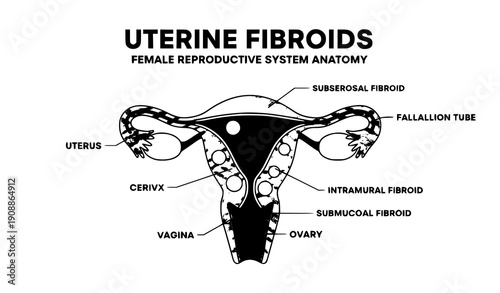 Female Reproductive System with Uterine Fibroids Labeled Anatomy