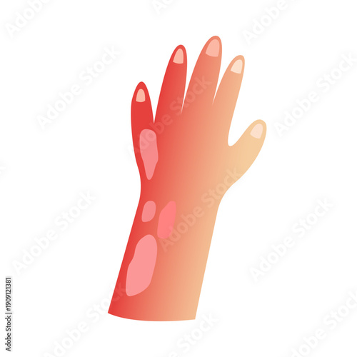 Burned skin. vector illustration design