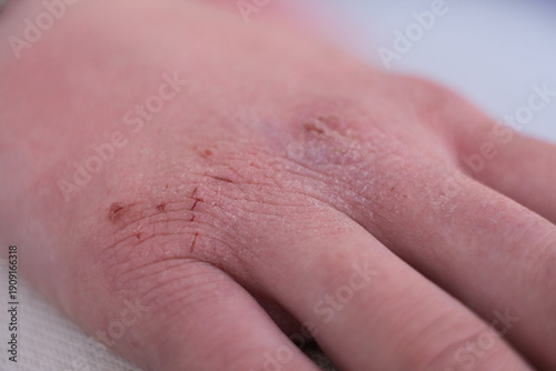 Contact dermatitis on hand shows symptoms of allergic reaction and irritation from unknown substances in daily life