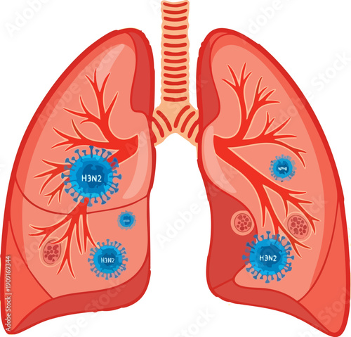Human lungs infected with H3N2 influenza virus, vector illustration of respiratory system with viral particles, isolated on white