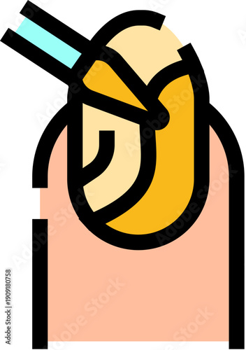 Hand with a discolored fingernail receiving treatment with a specialized tool, representing concepts of onychomycosis, healthcare, and medical procedures for nail fungal issues