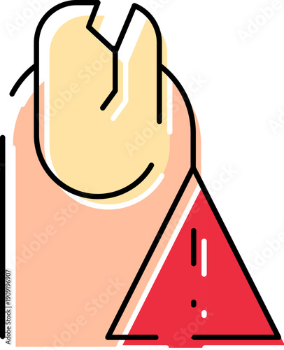 Fingernail experiencing brittleness and splitting damage, indicating a potential health issue or need for nail care, depicted with a red warning triangle