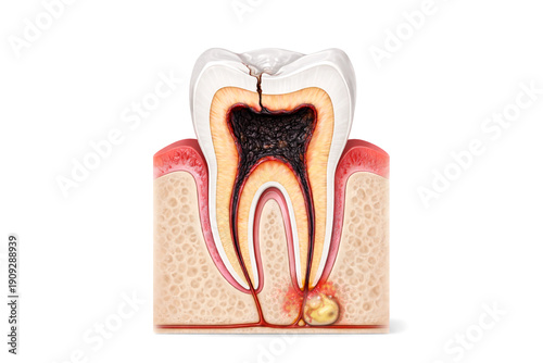Tooth Pulp Necrosis with Periapical Abscess Cross Section