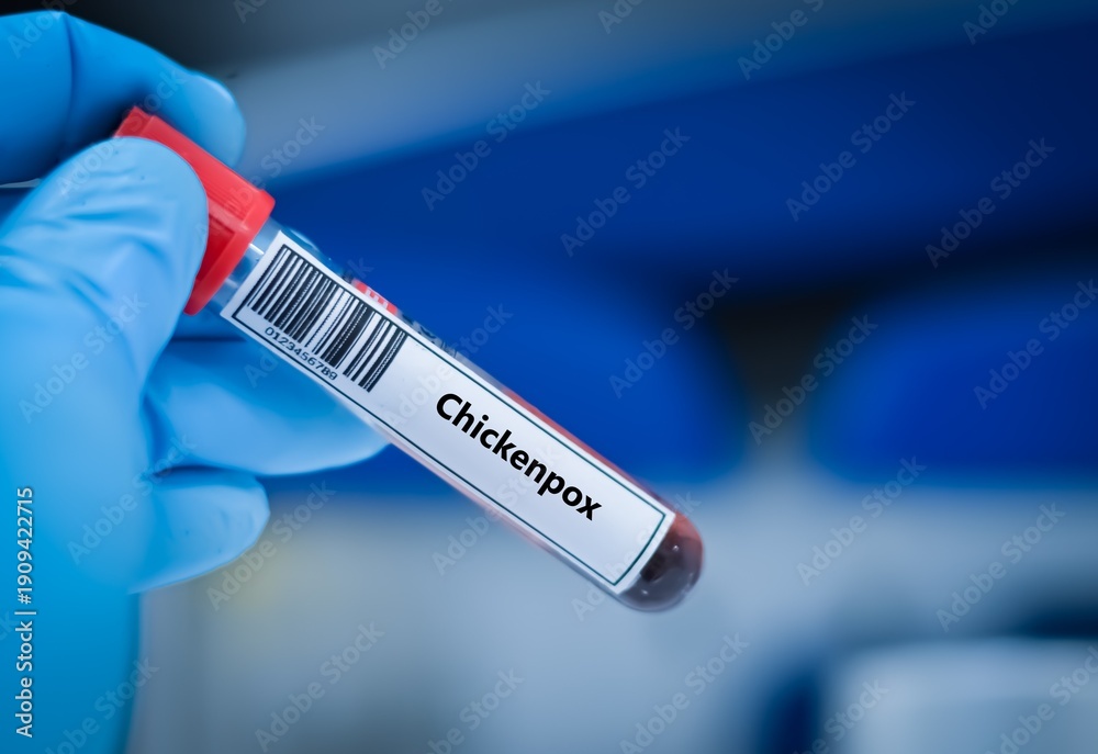 Obraz premium Blood sample tube for chickenpox virus test analysis.