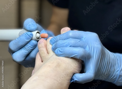 Close-up foot pedicure with electric file, podiatrist wearing blue gloves performs hardware debridement of thick fungal toenails in clinical salon, diabetic foot precautions observed, sterile.