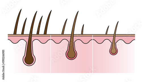 Flat icon step of hair losing with scalp layer vector illustration isolated on white background. Reduce, decrease, thin, remove, fall hair to alopecia, baldness and hair less. Hair anatomy concept.