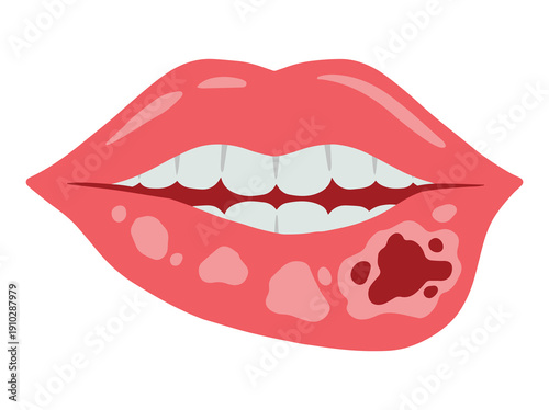 Actinic Cheilitis in Lip Disease