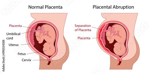 Female Diagram of the Normal placenta and placental abruption during pregnancy. Vaginal bleeding. Pathology, Pregnancy complication, threat of miscarriage. Vector medical illustration
