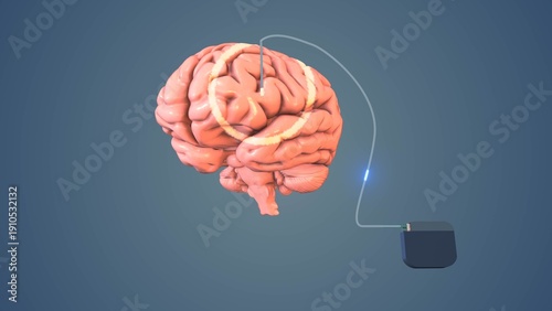 Implanted Neurostimulator Connected to Human Brain