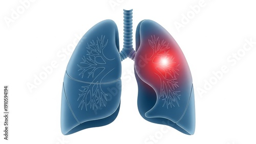 Medical illustration of human lungs showing inflammation or infection in the right organ