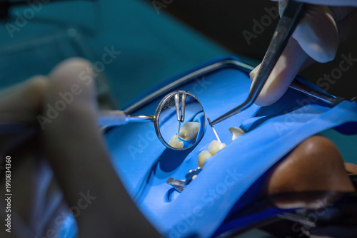 Tableau sur toile Root canal treatment under rubber dam isolation