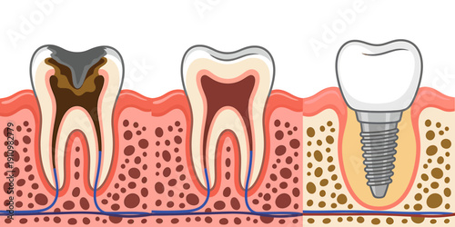 Crosssection of healthy and decayed teeth with dental implant  comparison