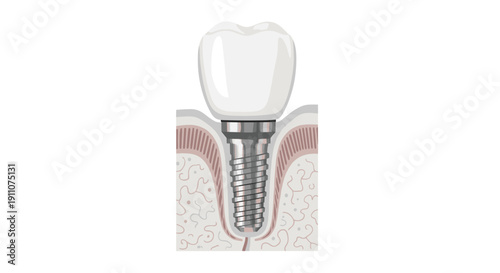 A detailed cross-section diagram illustrates a dental implant with screw, abutment, and crown, integrated into the jawbone.