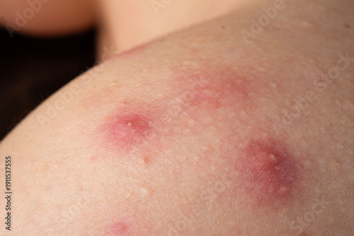 Foto Acne skin pimple