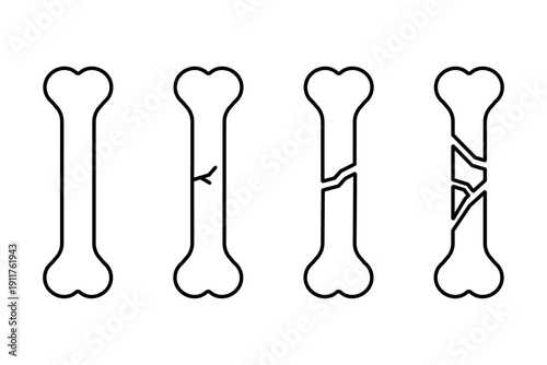 様々な骨折の状況を表現した骨のアイコンセット