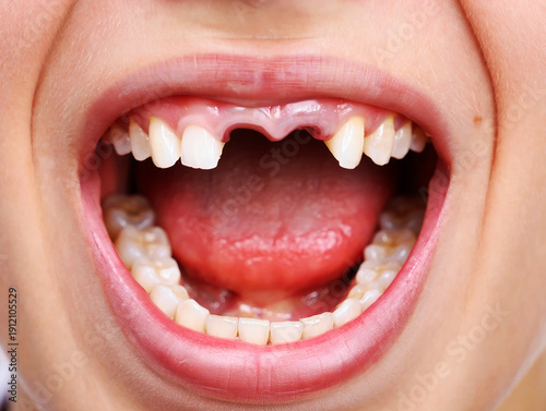 Close up of open mouth with missing front teeth and pink gums image