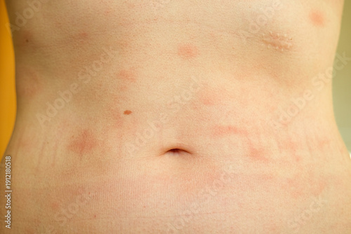 Atopic dermatitis on the abdominal skin of a woman, severe itching on the side. Allergy or urticaria, hives