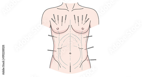 Illustration of a human torso with multiple acupuncture needles inserted into the chest, abdomen, and sides for pain relief and treatment.