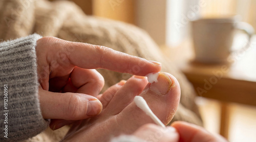 Woman experiencing skin peeling and discoloration on toe applying antifungal cream on infected toenail for fungus treatment at home