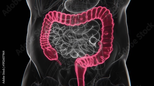 Diverticulitis Indication X-ray in HD Video | Diverticulitis X-ray in HD Video
