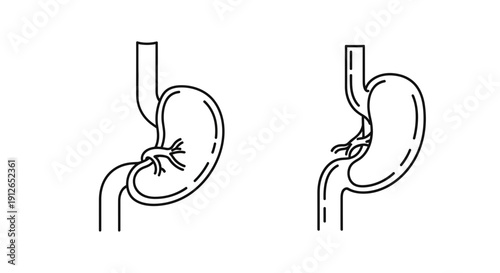 Gastric Bypass Surgery Diagram: Before and After Comparison of Stomach Anatomy