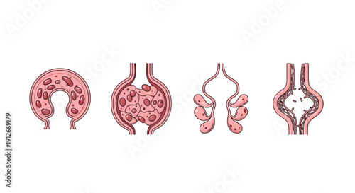 Cross-section of arteries showing atherosclerosis plaque buildup and blockage