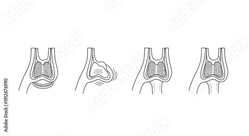 Anatomical illustration of a joint, showing different stages of movement and structure.