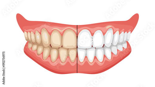 Close up of a human mouth showing comparison between stained yellow teeth and bright white teeth after a professional whitening.