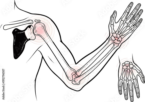 Anatomical illustration of a human arm and hand skeleton with joint pain indicators