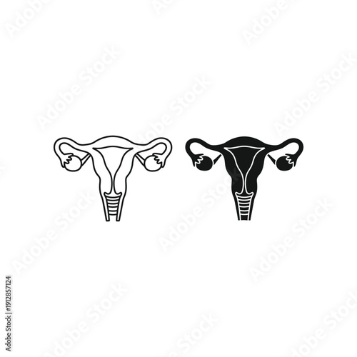 Anatomical illustration comparing a healthy uterus to one with fibroids.
