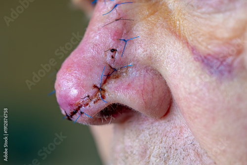 Health care concept, Selective focus of a man nose with surgical wound, Stitches and blood after operation, Basal-cell carcinoma (BCC) also known as basal-cell cancer is the common type of skin cancer