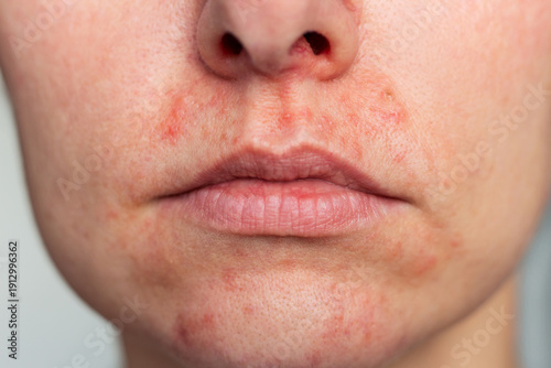Bild auf Leinwand Close-up portrait of young Caucasian woman suffering from perioral dermatitis near the mouth