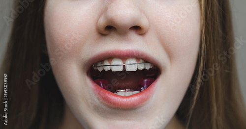 Fotografía Macro image of a teenage girl's teeth with orthodontic wire and purple plate installed, concept of pediatric dentistry and bite correction process