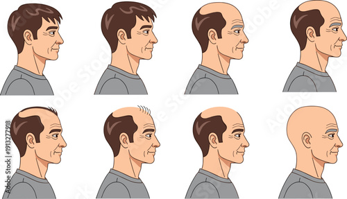Cartoon vector sequence showing progressive stages of male pattern baldness from full hair to complete baldness, educational dermatology aging concept illustration