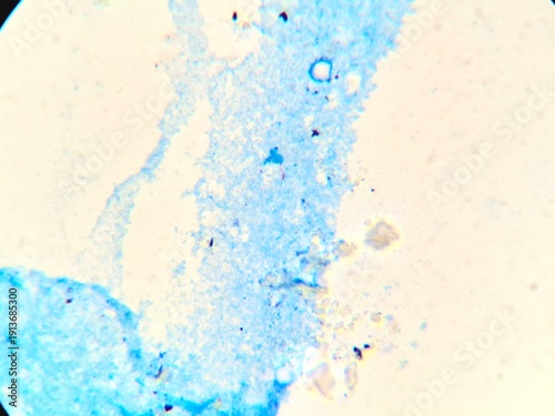 Bild auf Leinwand Microscopic view of Mycobacterium tuberculosis in a sputum smear using Ziehl-Neelsen staining