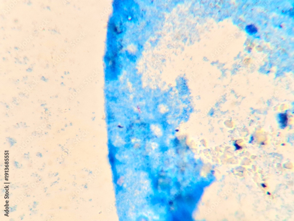 Fototapeta premium Microscopic view of Mycobacterium tuberculosis in a sputum smear using Ziehl-Neelsen staining. The acid-fast bacilli (AFB) appear as distinct bright red rod-shaped bacteria against a contrasting blue 