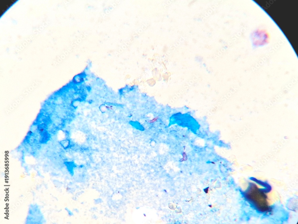 Fototapeta premium Microscopic view of Mycobacterium tuberculosis in a sputum smear using Ziehl-Neelsen staining. The acid-fast bacilli (AFB) appear as distinct bright red rod-shaped bacteria against a contrasting blue 