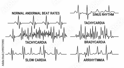 Diverse ECG wave patterns showing normal and abnormal heart rhythms