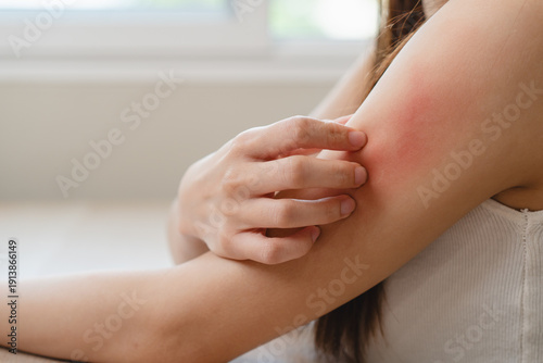 Konstfotografi Close-up of young woman scratch her arm have a red rash