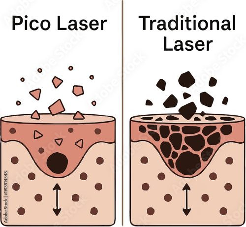  Create a realistic Pico laser vs traditional laser pigment breakdown comparison vector art with white background.