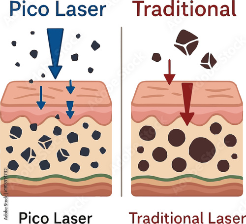  Create a realistic Pico laser vs traditional laser pigment breakdown comparison vector art with white background.